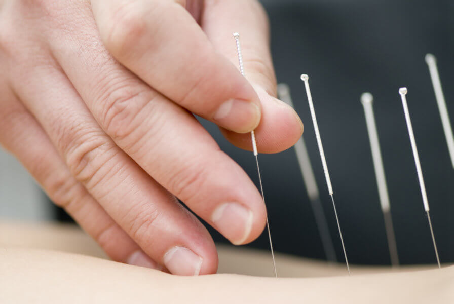 Acupuncture and IVF
